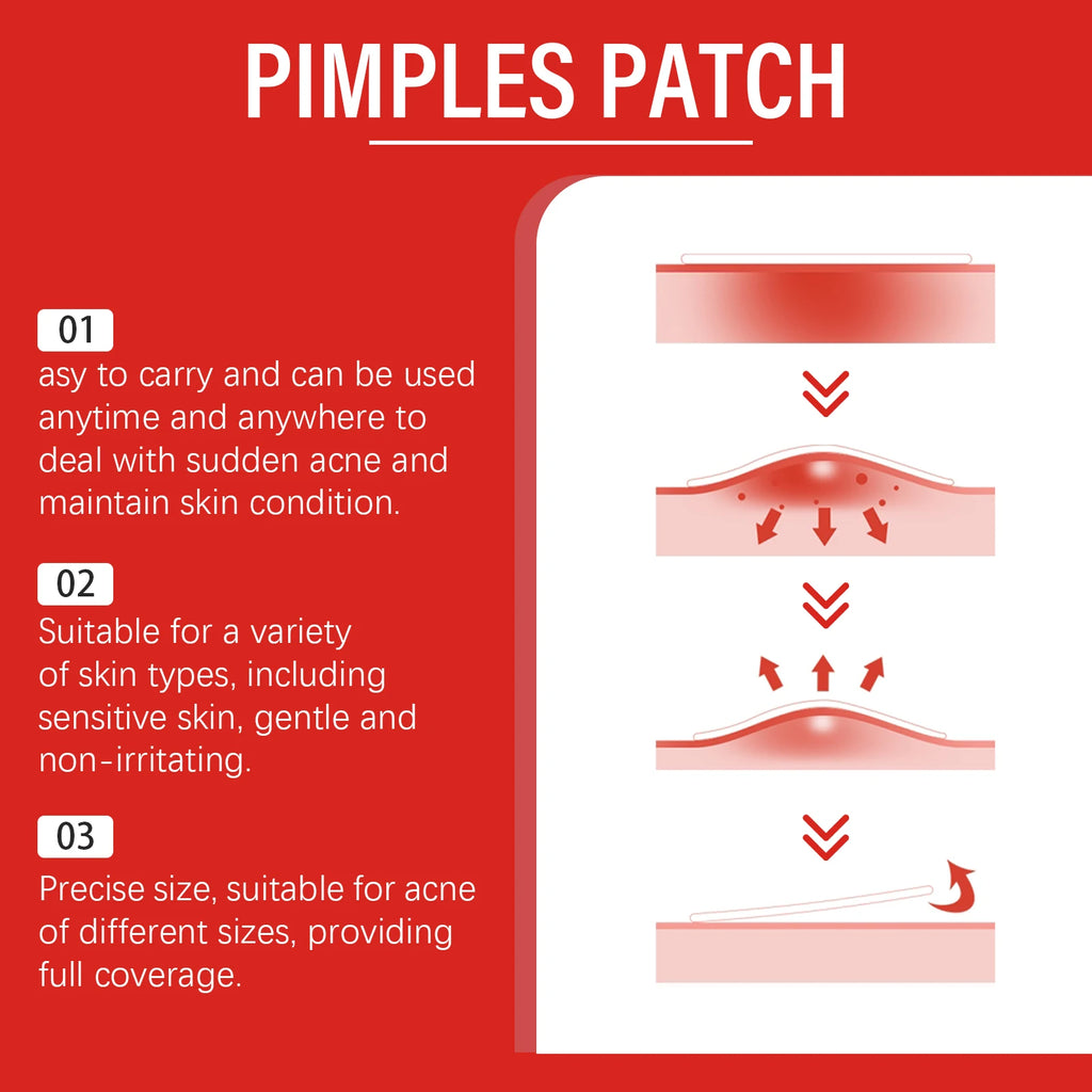 Salicylic Acid Acne Pimple Patches – 240pcs Colorful Spot Stickers