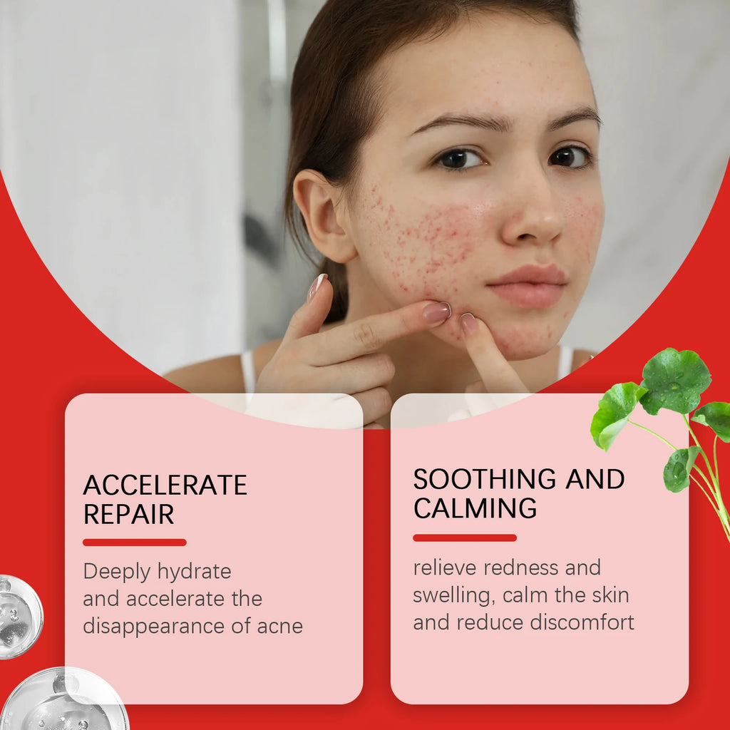 Salicylic Acid Acne Pimple Patches – 240pcs Colorful Spot Stickers